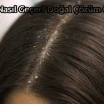 Kepek Nasıl Geçer? Doğal Çözüm Önerileri