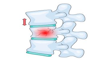 Omurga Kırığı: Osteoporozun En Yaygın ve Sessiz Sonuçlarından Biri