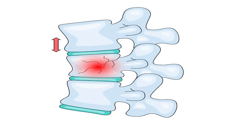 Omurga Kırığı: Osteoporozun En Yaygın ve Sessiz Sonuçlarından Biri