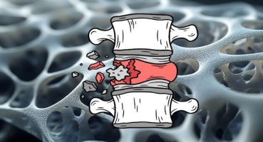 Günümüzde Artan Yaşlı Nüfus Nedeniyle Omurga Kırıkları Arttı mı?